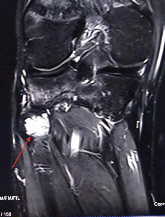 STIR magnetic resonance imaging coronal image with a hyperintense signal intensity in the right proximal fibula (arrow).
